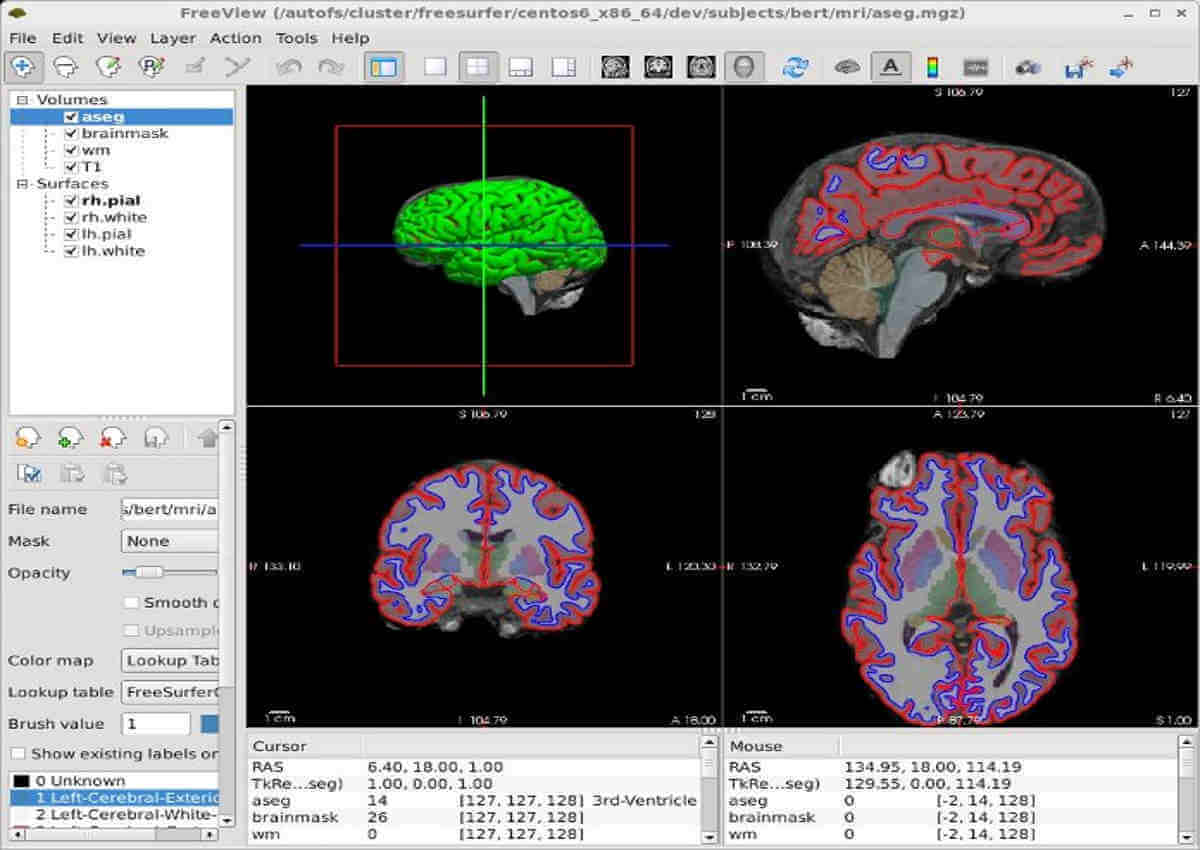 How To 3d Print Your Own Brain Using Mri Or Ct Scans And Free Software