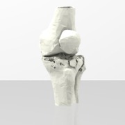 Knee - Proximal Tibia Fracture